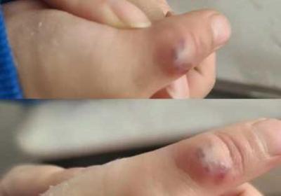 宝宝才三根手指就这么疼 宝宝才三根手指就痛怎么办呀